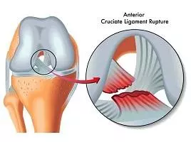 前十字韌帶撕裂，導致膝關節向前失穩