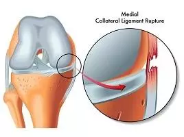 內側副韌帶撕裂，多見於足球受傷，常伴見前十字韌帶及內側半月板損傷