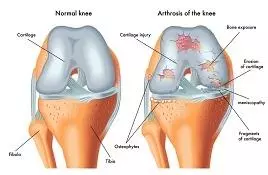 膝關節退化，症狀常見晨僵，上落樓梯疼痛，屈膝困難