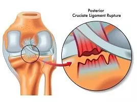 後十字韌帶撕裂，可導致膝關節向後失穩